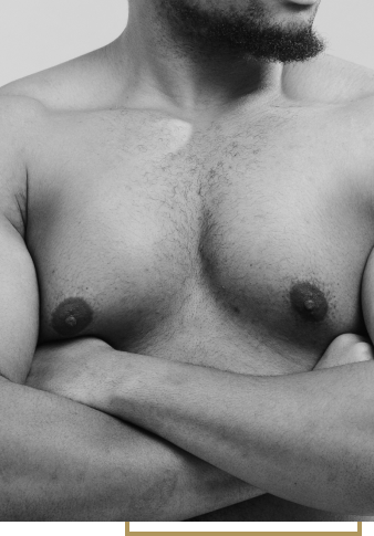 ginecomastia